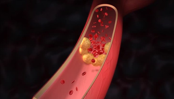 Няколко ключови фактора превръщат лошия холестерол в смъртоносна заплаха Няколко ключови фактора превръщат лошия холестерол в смъртоносна заплаха