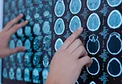 Изкуствен интелект откри 55 пропуснати от лекарите мозъчни аневризми Изкуствен интелект откри 55 пропуснати от лекарите мозъчни аневризми